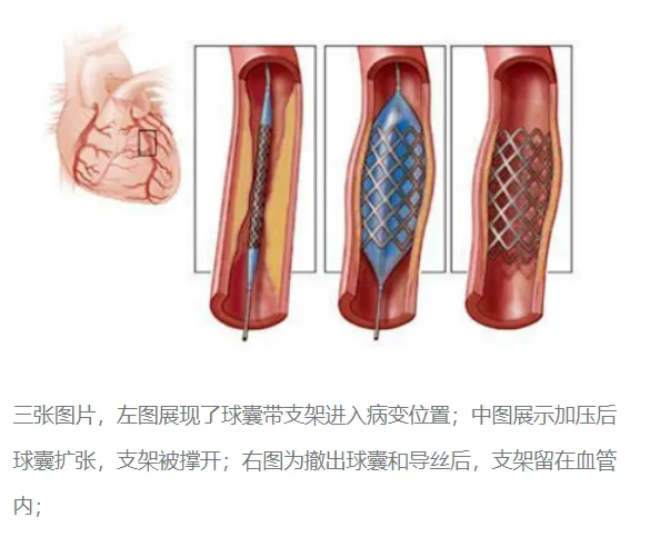 【健康科普】关于心脏支架你要知道的那些事